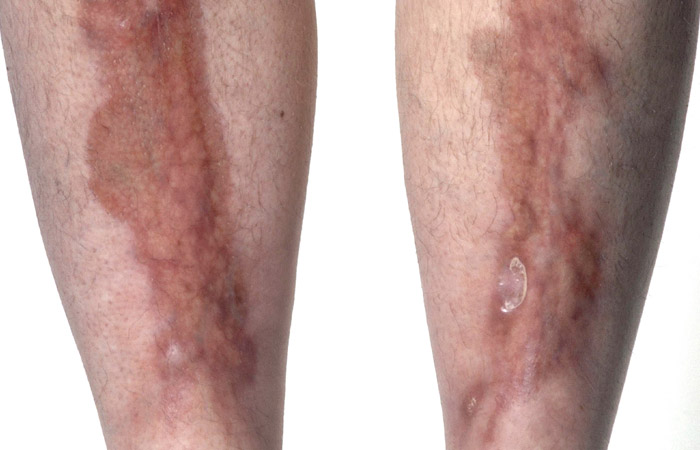 1-necrobiosis-lipoidica-copy