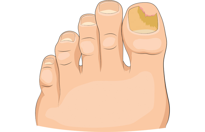 ingrown toenail.jpg