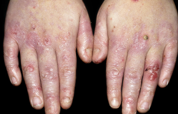 6-epidermolysis-bullosa-skin-disease
