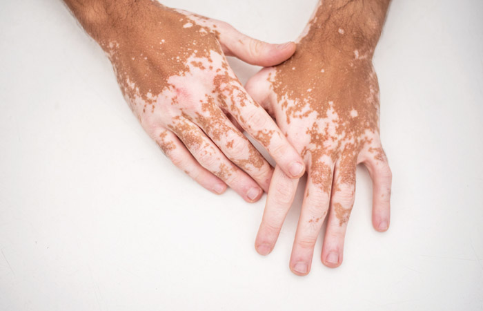 vitiligo